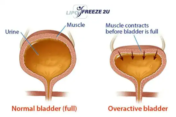 diagram of overactive bladder treatment Derbyshire
