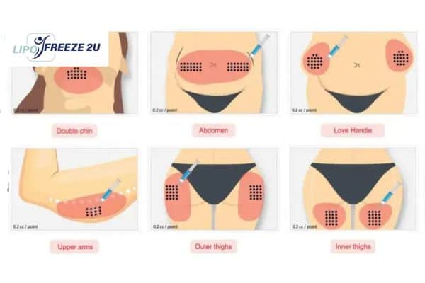 Benefits of Choosing Aqualyx for Fat Reduction Derbyshire
