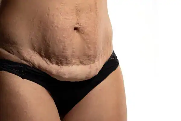 loose skin after weight loss injections Derbyshire
