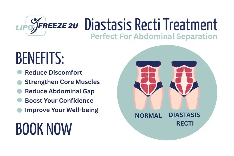 Benefits of body toning treatment Derbyshire for Diastasis recti