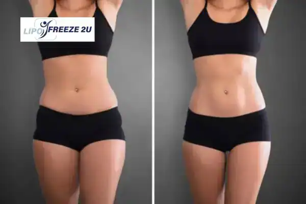 How Can LIPO FREEZE 2U Support Your Post-Pregnancy Body Recovery Derbyshire?