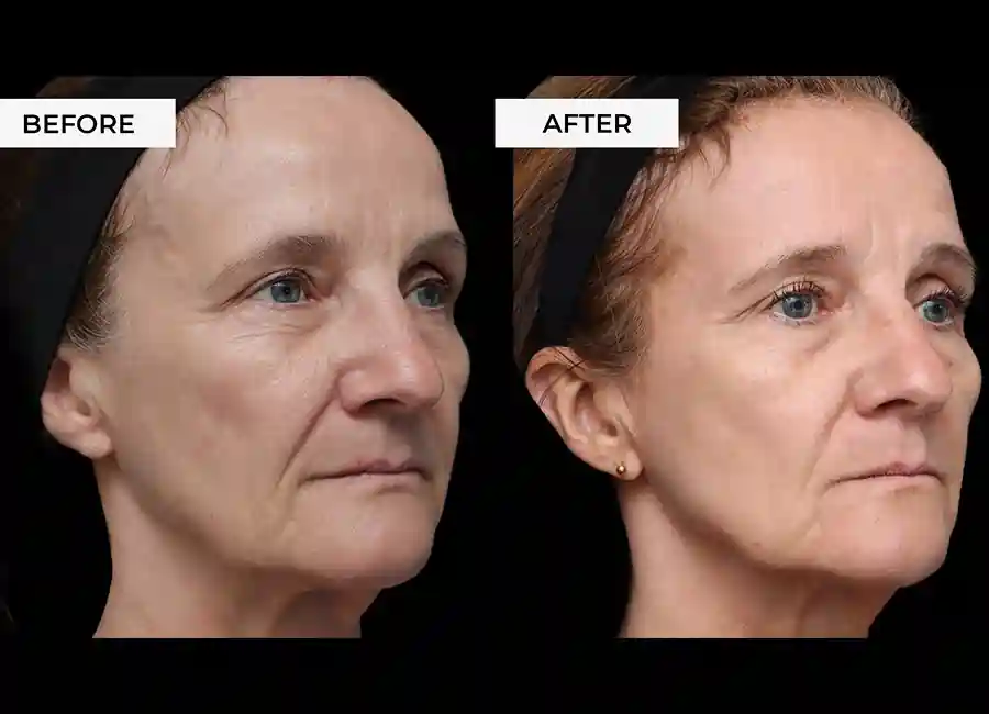 How Many RF Microneedling Sessions Will You Need to See a Difference Derbyshire?