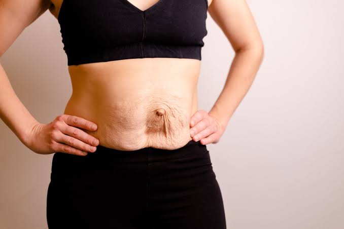 Is Surgery Really the Only Way to Repair Diastasis Recti Derbyshire?
