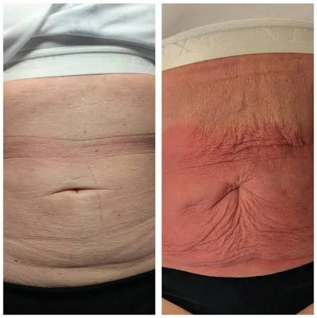 How Does RF Microneedling Improve Crepey, Thin and Uneven Skin Texture Derbyshire?