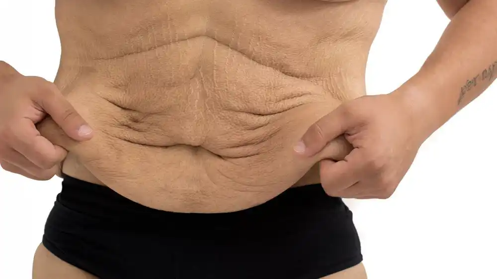 Why Does Weight Loss Medication Leave Some People With Loose or Sagging Skin Derbyshire?